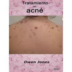 Owen Jones - Tratamiento Del Acné (e-könyv)