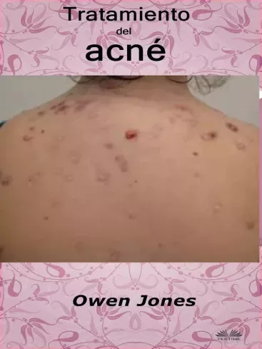 Owen Jones - Tratamiento Del Acné (e-könyv)